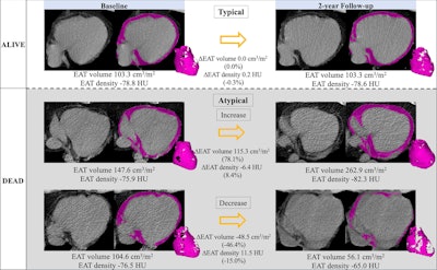 Epicardial adipose tissue (EAT) segmentation (shading) at noncontrast chest CT in axial orientation. Representative examples show EAT changes (ΔEAT) between baseline and two-year follow-up CT scans in participants who survived (typical changes) and increasing and decreasing EAT in participants who died. Images and caption courtesy of the RSNA.