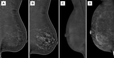 Images depict ongitudinal background parenchymal enhancement (BPE) changes at contrast-enhanced mammography (CEM) related to tamoxifen therapy and cessation. Recombined (A, B) left and (C, D) right mediolateral oblique CEM images in two different 51-year-old female patients who underwent imaging while receiving tamoxifen therapy (A, C) and after cessation of therapy (B, D) show minimal BPE during tamoxifen therapy, which increased to marked and moderate BPE grades, respectively, after cessation.