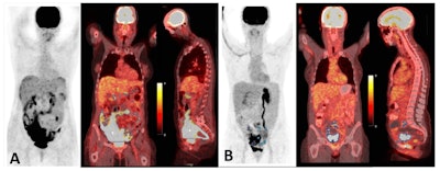 An example of two different patients with high and low tumor burden. (A) A 54-year-old patient with HGSOC; MTVtotal: 1,204 cm3, MTVtarget: 1,186 cm3, TLGtarget: 3768.6 mL × cm3, and TLGtotal: 3777.4 mL × cm3. DFS= 4 months. (B) A 50-year-old patient with HGSOC; MTVtotal: 194.8 cm3, MTVtarget: 152 cm3, TLGtarget: 542.6 mL × cm3, and TLGtotal: 261.2 mL × cm3. DFS = 44.9 months. Image and caption available for republishing under Creative Commons license (CC BY 4.0 DEED, Attribution 4.0 International) and courtesy of Cancers.