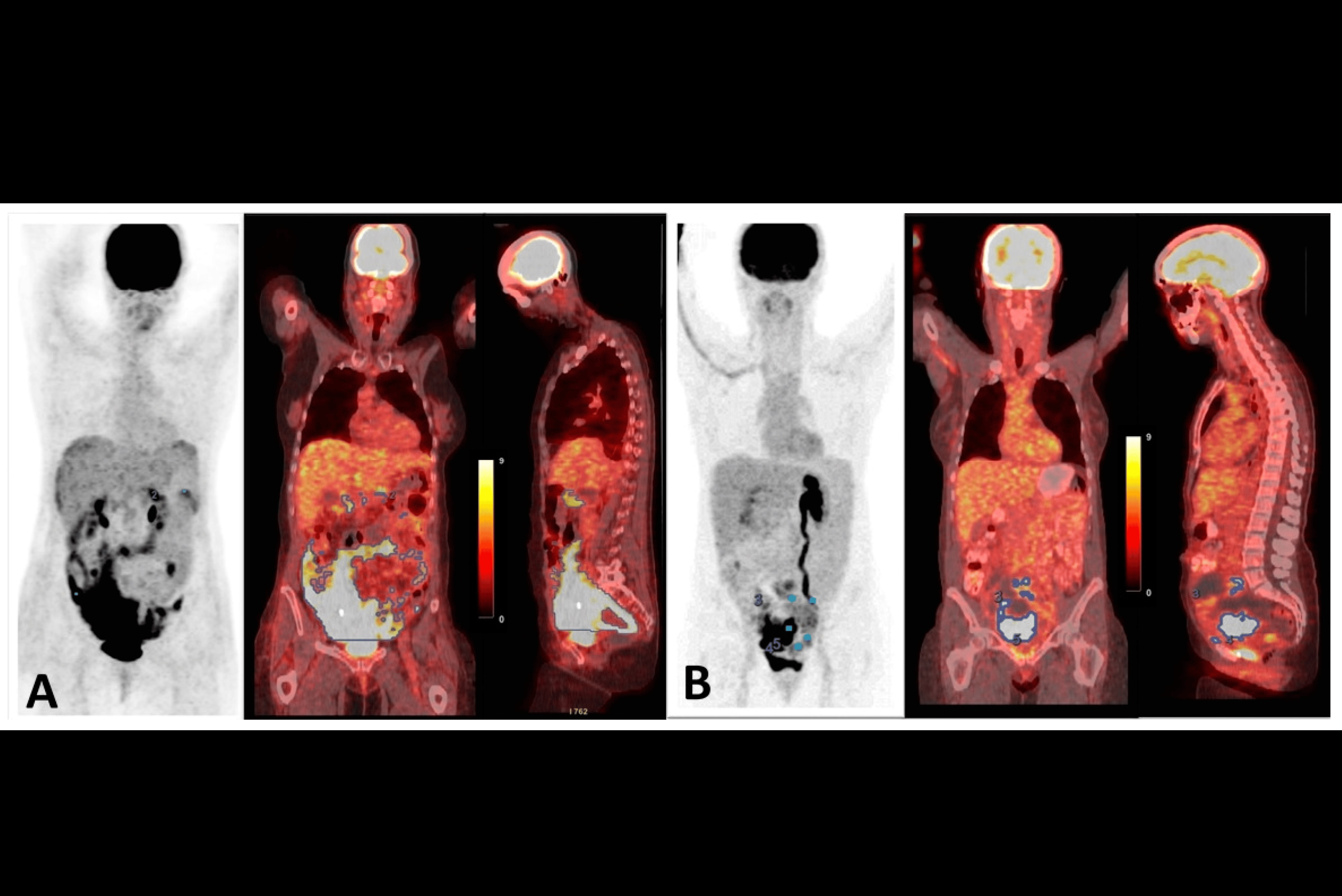 Ovarian Cancer Thumbnail