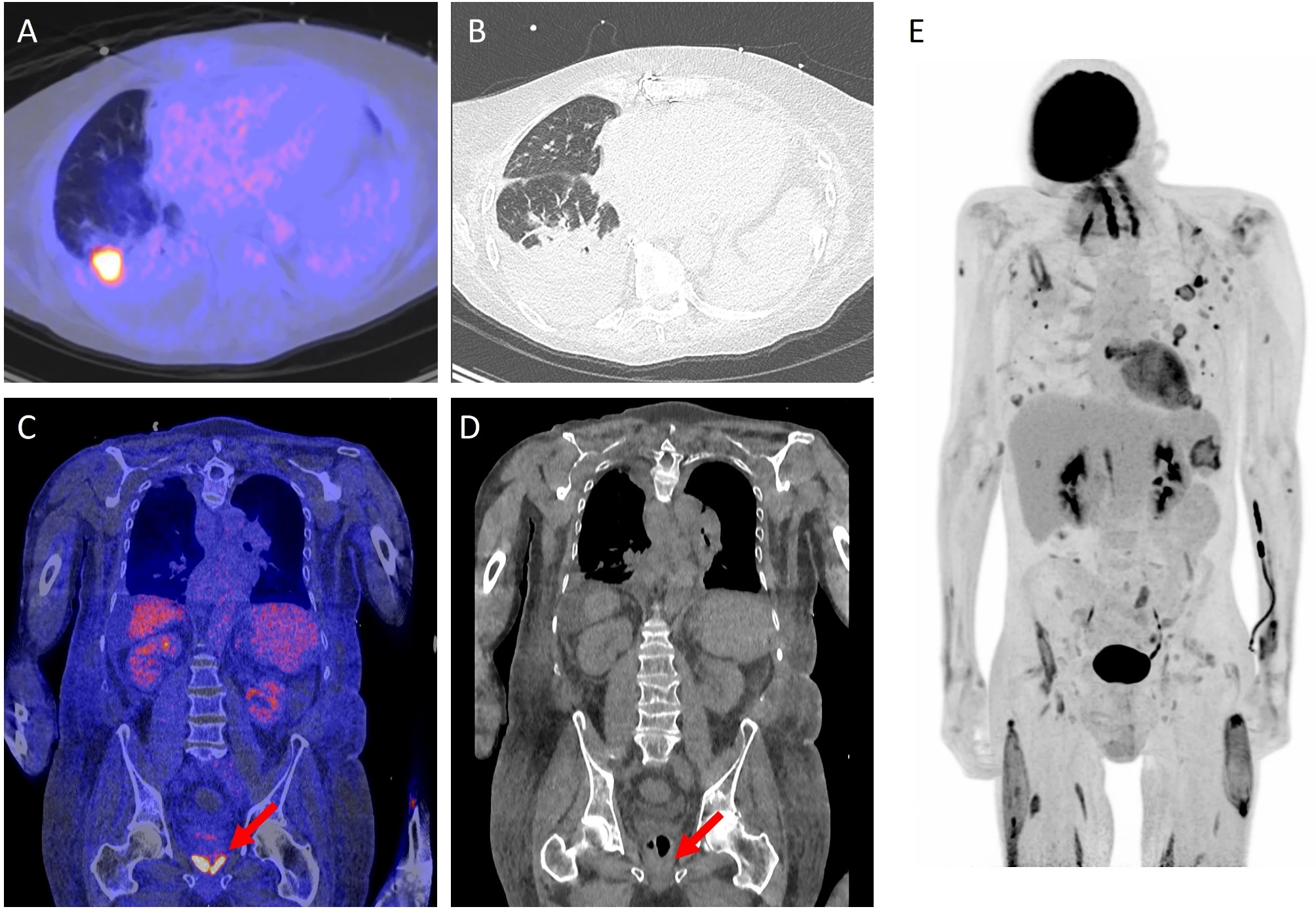 There are several conceivable advantages of F-18 FDG PET/CT over conventional imaging. Image A and B showing an example of the distinctive capability of the F-18 FDG PET/CT. A shows a fusion image of F-18 FDG PET/CT and low-dose CT and B an high resolution chest CT of a patient with an Aspergillus infection. The suspected aspergilloma is concealed on the high resolution CT due to the lung fluids and consolidation. Image C and D (fusion image of F-18 FDG PET/CT and low-dose CT and low-dose CT only, respectively) are examples of the ability to image inflammation while no concurrent abnormalities are visualized, in this case prostatitis (red arrows). Image E, a maximized intensity projection of F-18 FDG PET, shows a patient with lung infections and multiple muscle abscesses after MRSA sepsis. This is an illustrative example of a relevant dissemination investigation. Image and caption available for republishing under Creative Commons license (CC BY 4.0 DEED, Attribution 4.0 International) and courtesy of Annals of Intensive Care.