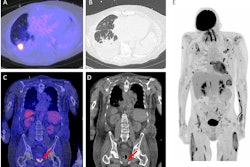 There are several conceivable advantages of F-18 FDG PET/CT over conventional imaging. Image A and B showing an example of the distinctive capability of the F-18 FDG PET/CT. A shows a fusion image of F-18 FDG PET/CT and low-dose CT and B an high resolution chest CT of a patient with an Aspergillus infection. The suspected aspergilloma is concealed on the high resolution CT due to the lung fluids and consolidation. Image C and D (fusion image of F-18 FDG PET/CT and low-dose CT and low-dose CT only, respectively) are examples of the ability to image inflammation while no concurrent abnormalities are visualized, in this case prostatitis (red arrows). Image E, a maximized intensity projection of F-18 FDG PET, shows a patient with lung infections and multiple muscle abscesses after MRSA sepsis. This is an illustrative example of a relevant dissemination investigation. Image and caption available for republishing under Creative Commons license (CC BY 4.0 DEED, Attribution 4.0 International) and courtesy of Annals of Intensive Care.