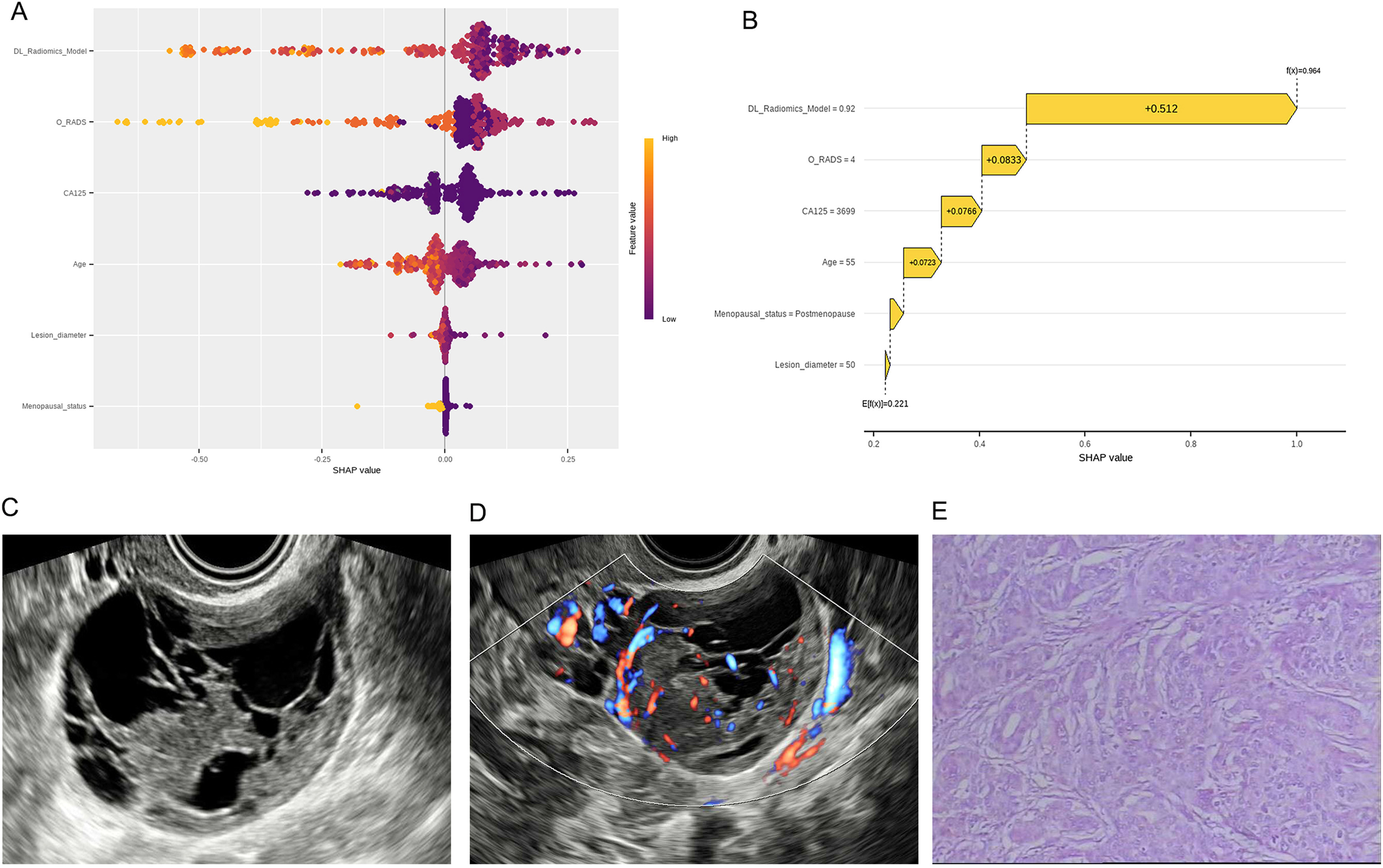 (A) SHAP summary plot shows the global contributions of variables to the model predictions. (B-E) Local explanation of the model for a single instance of ovarian endometrioid carcinoma: SHAP waterfall plot (B), ultrasound grayscale image (C), ultrasound color Doppler image (D), and 10&times;10 histopathological image (E). Images are available for republishing under a Creative Commons license (CC BY-NC-ND 4.0).