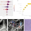 (A) SHAP summary plot shows the global contributions of variables to the model predictions. (B-E) Local explanation of the model for a single instance of ovarian endometrioid carcinoma: SHAP waterfall plot (B), ultrasound grayscale image (C), ultrasound color Doppler image (D), and 10×10 histopathological image (E). Images are available for republishing under a Creative Commons license (CC BY-NC-ND 4.0).