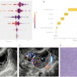 (A) SHAP summary plot shows the global contributions of variables to the model predictions. (B-E) Local explanation of the model for a single instance of ovarian endometrioid carcinoma: SHAP waterfall plot (B), ultrasound grayscale image (C), ultrasound color Doppler image (D), and 10×10 histopathological image (E). Images are available for republishing under a Creative Commons license (CC BY-NC-ND 4.0).