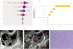 (A) SHAP summary plot shows the global contributions of variables to the model predictions. (B-E) Local explanation of the model for a single instance of ovarian endometrioid carcinoma: SHAP waterfall plot (B), ultrasound grayscale image (C), ultrasound color Doppler image (D), and 10×10 histopathological image (E). Images are available for republishing under a Creative Commons license (CC BY-NC-ND 4.0).