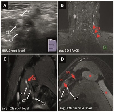 Images depict a 24-year-old male patient presenting with recurrent and exacerbating pain of his right shoulder with a difficulty to elevate (MRC 4+) his arm following a sports-related injury one year prior to imaging to rule out suspected plexus neuritis. On electrophysiology, only a borderline spontaneous activity pattern of the infraspinatus muscle was reported. On HRUS (A), the appearance of the supraclavicular plexus (dotted white line) was normal without suspicious alterations of nerve echogenicity or diameter. MRN of the proximal brachial plexus (B) suggested a possibly pathological T2 weighted signal increase at the conjunction of the inferior trunk (red dotted line) next to the unremarkable superior and middle trunk. However, there were no related clinical or electrophysiological findings. (C) Appearance of the distal, infraclavicular plexus segments including the lateral, medial, and posterior fascicles was normal as well as the suprascapular nerve. (D) No signs of muscular denervation of the supra- or infraspinatus muscles (*) were present on MRN. Therefore, a plexus neuritis or another nerve-related etiology was ruled out. An artificial signal increase, often caused by the magic-angle artifact, can lead to false-positive results on MRN and must be taken into consideration when interpreting MRN examinations. Images and caption courtesy of the RSNA.
