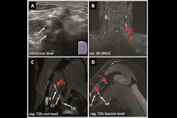 2025 03 04 Radiology Hrus Mrn Neuropathy Thumbnail
