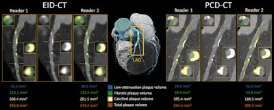 Representative example shows segmentations performed on the left anterior descending (LAD) artery in a 75-year-old male participant who underwent clinically indicated coronary CT angiography with energy-integrating detector (EID) CT and subsequently underwent photon-counting detector (PCD) CT. Whereas measurements were similar for all plaque components between readers, both investigators noted a substantially lower total plaque volume on the ultrahigh-spatial-resolution scan. The central three-dimensional volumetric image (middle) shows the location of the segmentations. Images and caption courtesy of the RSNA.