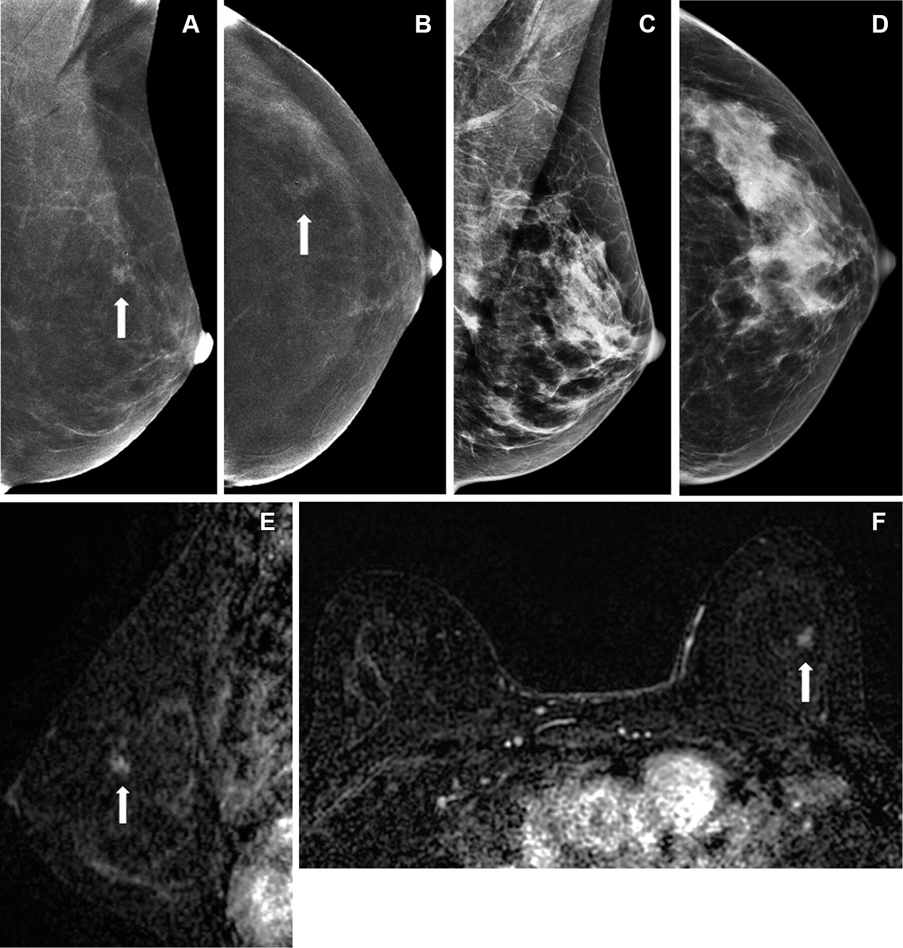 Images depict true-positive findings in a 51-year-old woman with a left breast focal nonmass enhancement. (A) Mediolateral oblique and (B) cranio-caudal contrast-enhanced mammographic (CEM) images show the enhancement (arrows). No correlate was identified on (C) mediolateral-oblique or (D) craniocaudal low-energy images, or whole-breast ultrasound (not shown). Contrast-enhanced breast MRI shows a suspicious enhancement on (E) sagittaland (F) axial subtraction images (arrows), correlating with the finding on CEM images. MRI-guided biopsy (not shown) showed flat epithelial atypia, withsubsequent surgery confirming ductal carcinoma in situ.