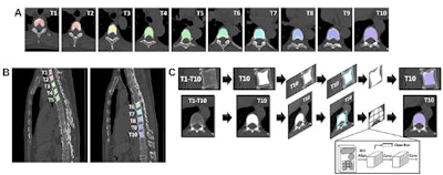 Two-dimensional (2D) axial and sagittal segmentation overview. Representative noncontrast chest CT Digital Imaging and Communications in Medicine (A) axial and (B) sagittal segmentation images show manual labeling (white region of interest [ROI]) overlayed with inferred ROI by using the 2D deep learning–derived algorithm. (C) A custom instance segmentation ROI inference pipeline was developed using PixelLib (https://github.com/ayoolaolafenwa/PixelLib) and Mask R-CNN (https://github.com/matterport/Mask_RCNN). Representative noncontrast chest CT images show T10 examined by each step of the 2D deep learning–derived algorithm. In the inset box in C, the ROI alignment and deep learning process are illustrated, which results in a final segmentation (right side), where the inferred ROI is shown (purple area). Conv = convolution. Images and caption courtesy of the RSNA.