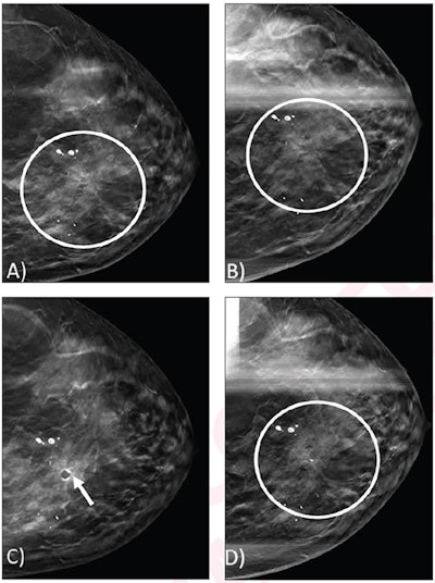 (A) Craniocaudal view from screening DBT mammogram shows architectural distortion (circle) in the upper inner position, which was not detected by digital mammography (not shown). (B) Spot craniocaudal view from subsequent diagnostic DBT mammogram shows persistence of architectural distortion (circle). No ultrasound correlate was identified (not shown). Core needle biopsy of the architectural distortion was performed, yielding a radial scar without atypia. (C) Post-biopsy mammogram shows cylinder clip (arrow) in appropriate position. Biopsy result was considered concordant, and patient underwent recommended imaging surveillance. (D) Spot craniocaudal view from diagnostic mammogram performed 12 months later shows stable appearance of an architectural distortion (circle).