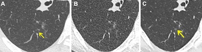 Axial noncontrast chest CT lung window images in a 61-year-old female participant. (A) Normal-dose CT, (B) ultralow-dose CT (ULDCT), and (C) denoised ULDCT show focal ground-glass opacity (yellow arrow). Ground-glass opacity was correctly identified with both normal-dose CT and denoised ULDCT, but it was missed by both readers at ULDCT due to decreased signal-to-noise ratio. Images and caption courtesy of the RSNA.