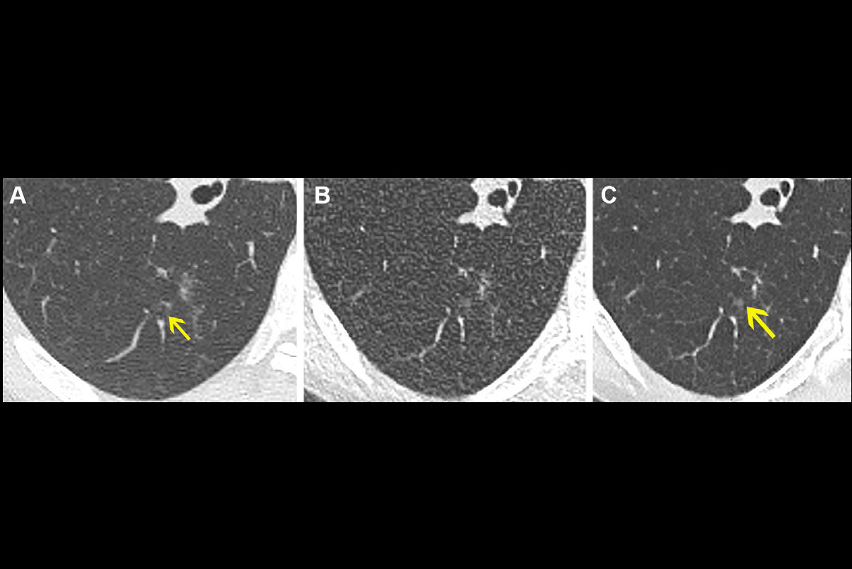 2025 03 13 Radiology Klug Figure4 Thumbnail