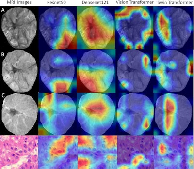 Deep-learning radiopathomics models visualization. (A-D) Gradient-weighted class activation mapping (Grad-CAM) heatmaps of ResNet50, DenseNet121, Vision Transformer, and Swin Transformer models are shown based on the axial arterial-phase images, portal venous phase images, hepatobiliary phase images, and hematoxylin eosin-stained images (original magnification, ×100) in a 71-year-old female patient with hepatocellular carcinoma. Red designates the activation region associated with vessels completely encapsulating tumor clusters. Images and caption courtesy of the RSNA.
