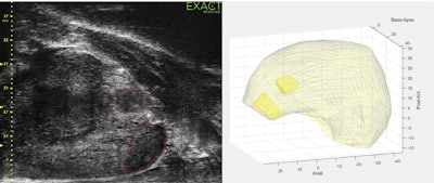 Images show the measurement of micro-ultrasound prostate and tumor volume using ExactVuTM dedicated software. Images are available for republishing under a Creative Commons license (CC BY 4.0).