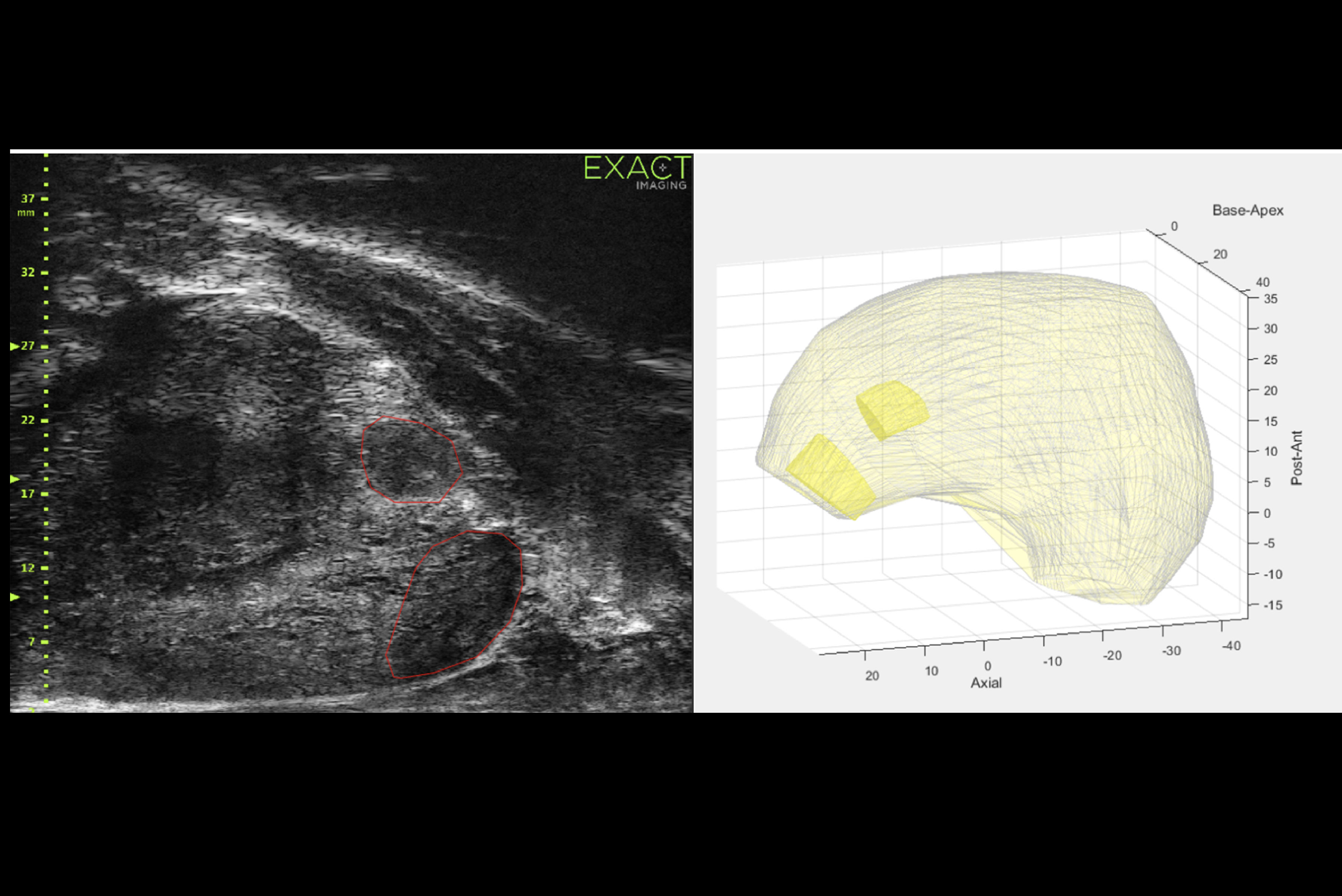 2025 03 14 Micro Ultrasound Prostate Thumbnail