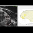 2025 03 14 Micro Ultrasound Prostate Thumbnail