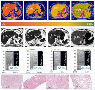 Liver fat fraction assessment in participants with varying degrees of hepatic steatosis. Fat fraction values were measured in regions of interest (circles) in the right liver lobe on axial contrast-enhanced photon-counting CT fat maps (first row), shown with corresponding proton density fat fraction measurements on axial MRI scans (second row), controlled attenuation parameter measurements from transient elastography (third row), and photomicrographs (hematoxylin-eosin stain; scale bars = 50 μm) of histologic samples (fourth row). Images and caption courtesy of the RSNA.