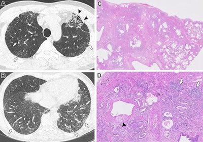 Images in a 57-year-old female with an indeterminate usual interstitial pneumonia (UIP) pattern at CT and pathologic UIP with interstitial pneumonia with autoimmune features (IPAF). (A, B) Axial noncontrast chest CT scans show a multifocal subpleural and patchy peribronchovascular distribution of ground-glass opacities, interspersed with fine reticulation and traction bronchiolectasis (arrows on A and B) that diffusely involves both lungs without a significant basal predominance. Focal areas of layered cysts with traction bronchiectasis and bronchiolectasis are noted in the left upper lobe (arrowheads on A). (C) In the pathologic specimen (original magnification, ×0.5; hematoxylin-eosin stain), the low power view shows patchy, heterogeneous involvement of end-stage fibrosis in subpleural and peripheral distribution with marked pleural and parenchymal cellular infiltration. (D) The high-power view (original magnification, ×0.5; hematoxylin-eosin stain) shows marked lymphoplasmacytic infiltration with lymphoid follicles and lymphoid aggregations (arrows) and multifocal fibroblastic foci (arrowhead). Serologic tests revealed antinuclear antibodies (titer, 1:160) with nucleolar pattern. Therefore, the patient was classified as having IPAF. The fibrosis score was 33.9% at the quantification analysis. The diffusing capacity of the lung for carbon monoxide on initial pulmonary function test was 66%. Despite use of an antifibrotic agent, follow-up CT at 1.2 years showed fibrotic progression of the interstitial lung disease (image not shown). However, the patient was alive 5.3 years after undergoing the initial CT scan. Images and caption courtesy of the RSNA.