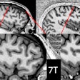 Comparison showing 3-tesla and 7-tesla scans for the same participant. Image courtesy of P Simon Jones, PhD, of the University of Cambridge.