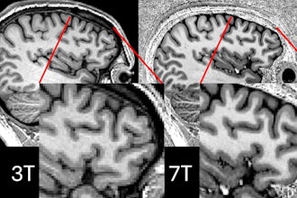 Comparison showing 3-tesla and 7-tesla scans for the same participant. Image courtesy of P Simon Jones, PhD, of the University of Cambridge.