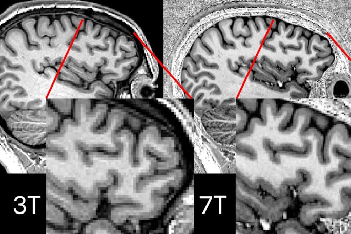 Comparison showing 3-tesla and 7-tesla scans for the same participant. Image courtesy of P Simon Jones, PhD, of the University of Cambridge.