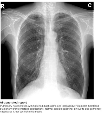 An example that features an AI-generated report that identified “scattered pulmonary granulomatous calcifications.” In the first session, three of five readers specifically reported the presence of a nodule. Following the introduction of the AI-generated report, only one reader maintained the specific mention of a nodule, whereas the other four readers adapted their reports to include the AI-suggested terminology of “granulomatous calcifications.” AP = anterior-posterior. Image and caption courtesy of RSNA.