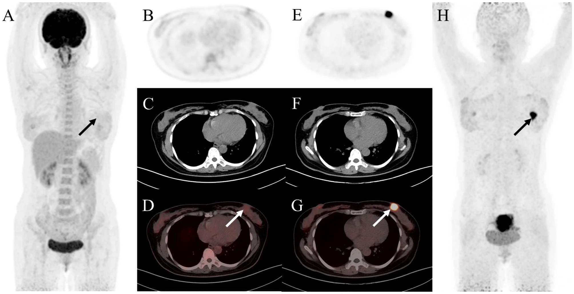 FAPI-PET/CT shows promise in gynecological cancers | AuntMinnie