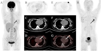 A 47-year-old woman was admitted with a left breast mass. For staging, the patient underwent F-18 FDG-PET/CT. The maximal intensity projection image (A) and the axial views (B: PET image; C: CT scan; D: PET/CT fused image) revealed normal findings. Then she underwent Ga-68 FAPI-PET/CT. The left breast showed intense uptake on Ga-68 FAPI-PET/CT (E: PET image; F: CT scan; G: PET/CT fused image; H: MIP, solid arrow; SUVmax, 15.4). Subsequently, the patient underwent pathology confirmed invasive lobular carcinoma of the left breast. Image and caption available for republishing under Creative Commons license (CC BY 4.0 DEED, Attribution 4.0 International) and courtesy of Cancer Imaging.