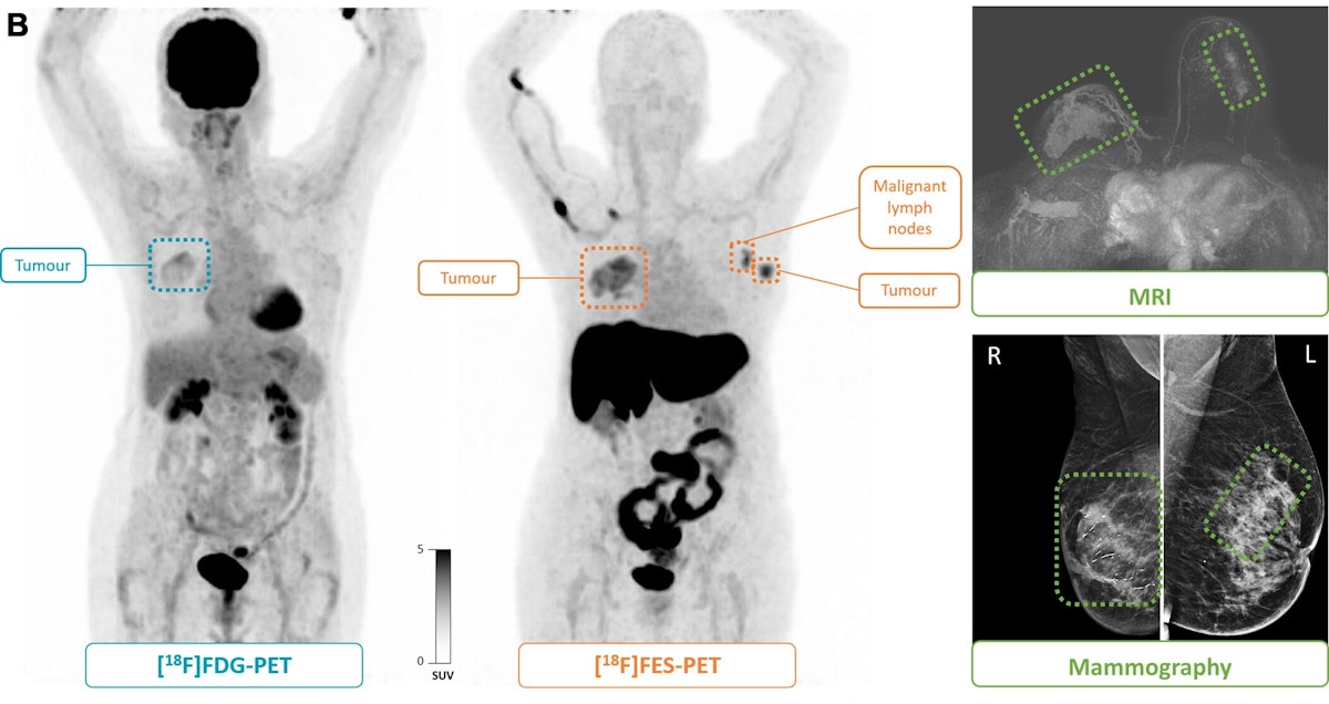 Diagnostic Breast Imaging 第2版 Diagnostic Breast Imaging