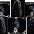 Representative examples of visual TAC categories, assessed on chest CT in asymptomatic individuals undergoing general health screening (blue indicates segmented TAC at level of aortic arch). Axial (A) and sagittal volume-rendered (B) images in 42-year-old patient. AI-based quantification yielded TAC volume of 101 mm3 and TAC Agatston score of 105. Examination was assessed as showing visually mild TAC. Axial (C) and sagittal volume-rendered (D) images in 57-year-old patient. AI-based quantification yielded TAC volume of 834 mm3 and TAC Agatston score of 993. Examination was assessed as showing visually moderate TAC. Axial (E) and sagittal volume-rendered (F) images in 65-year-old patient. AI-based quantification yielded TAC volume of 4872 mm3 and TAC Agatston score of 5848. Examination was assessed as showing visually severe TAC. Images and caption courtesy of the AJR.