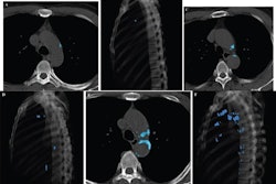 Representative examples of visual TAC categories, assessed on chest CT in asymptomatic individuals undergoing general health screening (blue indicates segmented TAC at level of aortic arch). Axial (A) and sagittal volume-rendered (B) images in 42-year-old patient. AI-based quantification yielded TAC volume of 101 mm3 and TAC Agatston score of 105. Examination was assessed as showing visually mild TAC. Axial (C) and sagittal volume-rendered (D) images in 57-year-old patient. AI-based quantification yielded TAC volume of 834 mm3 and TAC Agatston score of 993. Examination was assessed as showing visually moderate TAC. Axial (E) and sagittal volume-rendered (F) images in 65-year-old patient. AI-based quantification yielded TAC volume of 4872 mm3 and TAC Agatston score of 5848. Examination was assessed as showing visually severe TAC. Images and caption courtesy of the AJR.
