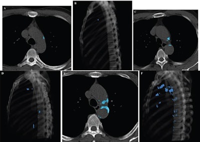 Representative examples of visual TAC categories, assessed on chest CT in asymptomatic individuals undergoing general health screening (blue indicates segmented TAC at level of aortic arch). Axial (A) and sagittal volume-rendered (B) images in 42-year-old patient. AI-based quantification yielded TAC volume of 101 mm3 and TAC Agatston score of 105. Examination was assessed as showing visually mild TAC. Axial (C) and sagittal volume-rendered (D) images in 57-year-old patient. AI-based quantification yielded TAC volume of 834 mm3 and TAC Agatston score of 993. Examination was assessed as showing visually moderate TAC. Axial (E) and sagittal volume-rendered (F) images in 65-year-old patient. AI-based quantification yielded TAC volume of 4872 mm3 and TAC Agatston score of 5848. Examination was assessed as showing visually severe TAC. Images and caption courtesy of the AJR.