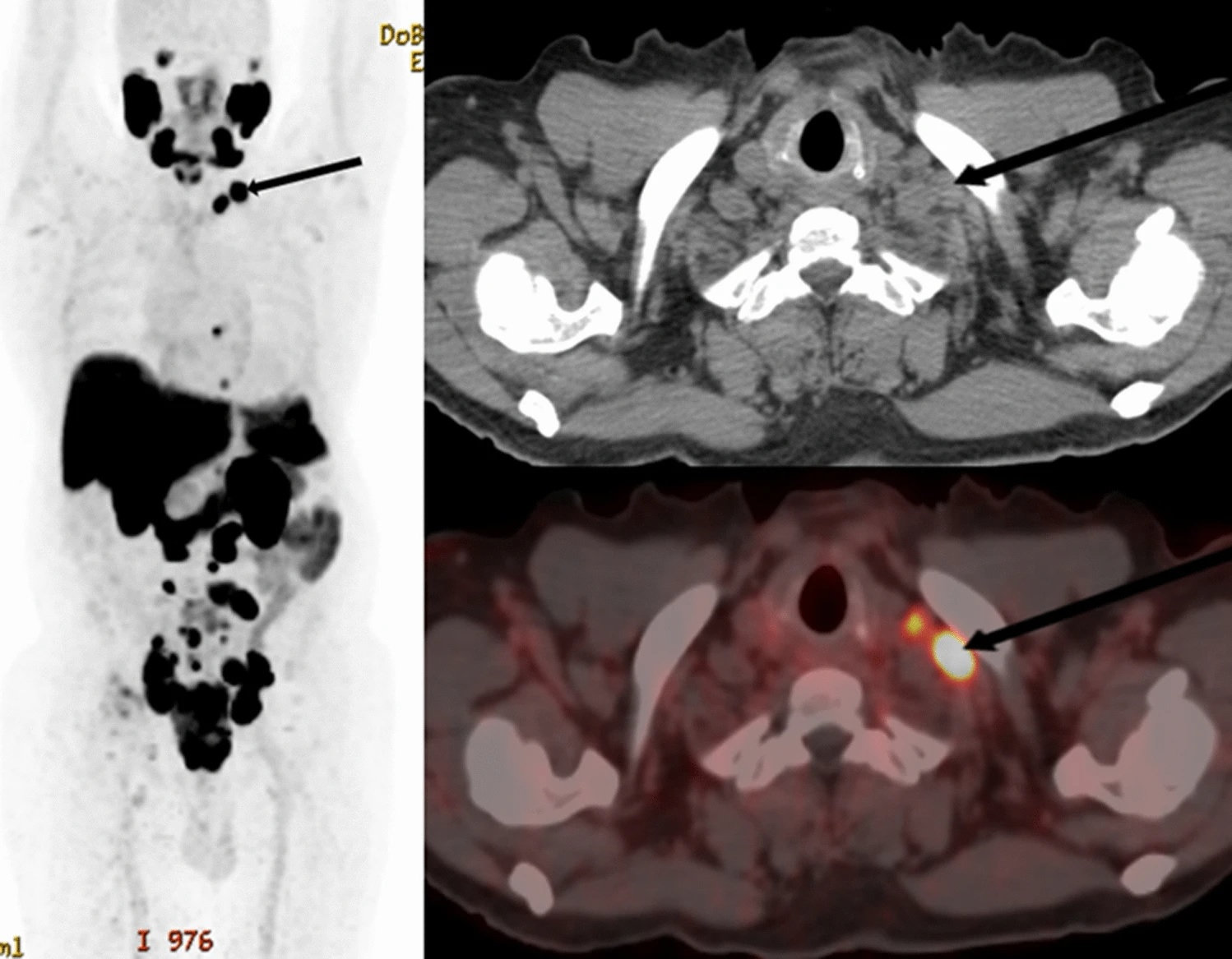 F-18 PSMA-1007 PET/CT of a 70 year old with newly diagnosed prostate cancer: PSA 770 ng/ml; Gleason 5 + 5; International Society of Urological Pathology grade 5. The maximum intensity projection images, CT, and fused images show PSMA ligand-avid prostate primary with pelvic, retroperitoneal, and mediastinal nodal spread. Additionally, he had left supraclavicular nodal metastasis (arrows). Image and caption available for republishing under Creative Commons license (CC BY 4.0 DEED, Attribution 4.0 International) and courtesy of EJNMMI Reports.