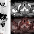 F-18 PSMA-1007 PET/CT of a 70 year old with newly diagnosed prostate cancer: PSA 770 ng/ml; Gleason 5 + 5; International Society of Urological Pathology grade 5. The maximum intensity projection images, CT, and fused images show PSMA ligand-avid prostate primary with pelvic, retroperitoneal, and mediastinal nodal spread. Additionally, he had left supraclavicular nodal metastasis (arrows). Image and caption available for republishing under Creative Commons license (CC BY 4.0 DEED, Attribution 4.0 International) and courtesy of EJNMMI Reports.