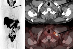 F-18 PSMA-1007 PET/CT of a 70 year old with newly diagnosed prostate cancer: PSA 770 ng/ml; Gleason 5 + 5; International Society of Urological Pathology grade 5. The maximum intensity projection images, CT, and fused images show PSMA ligand-avid prostate primary with pelvic, retroperitoneal, and mediastinal nodal spread. Additionally, he had left supraclavicular nodal metastasis (arrows). Image and caption available for republishing under Creative Commons license (CC BY 4.0 DEED, Attribution 4.0 International) and courtesy of EJNMMI Reports.
