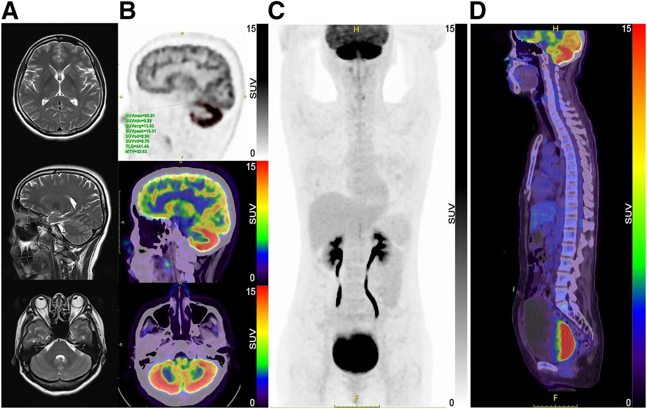 Brain MRI and F-18 FDG brain and whole-body PET/CT images. (A) No obvious abnormalities were found in axial and sagittal slices from T2-weighted MR images. (B) Whole cerebellar cortex had diffuse F-18 FDG hypermetabolism in PET/CT brain images, with SUVmax of 25.91. (C and D) Whole-body F-18 FDG-PET/CT showing distended bladder. TLG = total lesion glycolysis; MTV = metabolic tumor volume. Image and caption courtesy of the Journal of Nuclear Medicine.
