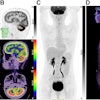 Brain MRI and F-18 FDG brain and whole-body PET/CT images. (A) No obvious abnormalities were found in axial and sagittal slices from T2-weighted MR images. (B) Whole cerebellar cortex had diffuse F-18 FDG hypermetabolism in PET/CT brain images, with SUVmax of 25.91. (C and D) Whole-body F-18 FDG-PET/CT showing distended bladder. TLG = total lesion glycolysis; MTV = metabolic tumor volume. Image and caption courtesy of the Journal of Nuclear Medicine.