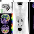 Brain MRI and F-18 FDG brain and whole-body PET/CT images. (A) No obvious abnormalities were found in axial and sagittal slices from T2-weighted MR images. (B) Whole cerebellar cortex had diffuse F-18 FDG hypermetabolism in PET/CT brain images, with SUVmax of 25.91. (C and D) Whole-body F-18 FDG-PET/CT showing distended bladder. TLG = total lesion glycolysis; MTV = metabolic tumor volume. Image and caption courtesy of the Journal of Nuclear Medicine.