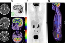 Brain MRI and F-18 FDG brain and whole-body PET/CT images. (A) No obvious abnormalities were found in axial and sagittal slices from T2-weighted MR images. (B) Whole cerebellar cortex had diffuse F-18 FDG hypermetabolism in PET/CT brain images, with SUVmax of 25.91. (C and D) Whole-body F-18 FDG-PET/CT showing distended bladder. TLG = total lesion glycolysis; MTV = metabolic tumor volume. Image and caption courtesy of the Journal of Nuclear Medicine.