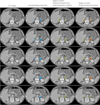 Example CT scans in a 77-year-old man with a left adrenal nodule. First panel shows raw CT scan. Second panel shows the annotated ground truth, the definitive reference for adrenal nodules. Light blue is the area of normal adrenal gland, and darker blue is the area of an adrenal nodule. Third panel shows the bounding box, a rectangular border that encloses adrenal nodules, generated by the first stage of the deep-learning model. Fourth panel shows the output of the second stage of the deep-learning model. The predicted area of an adrenal nodule is marked in red. Images and caption courtesy of the RSNA.
