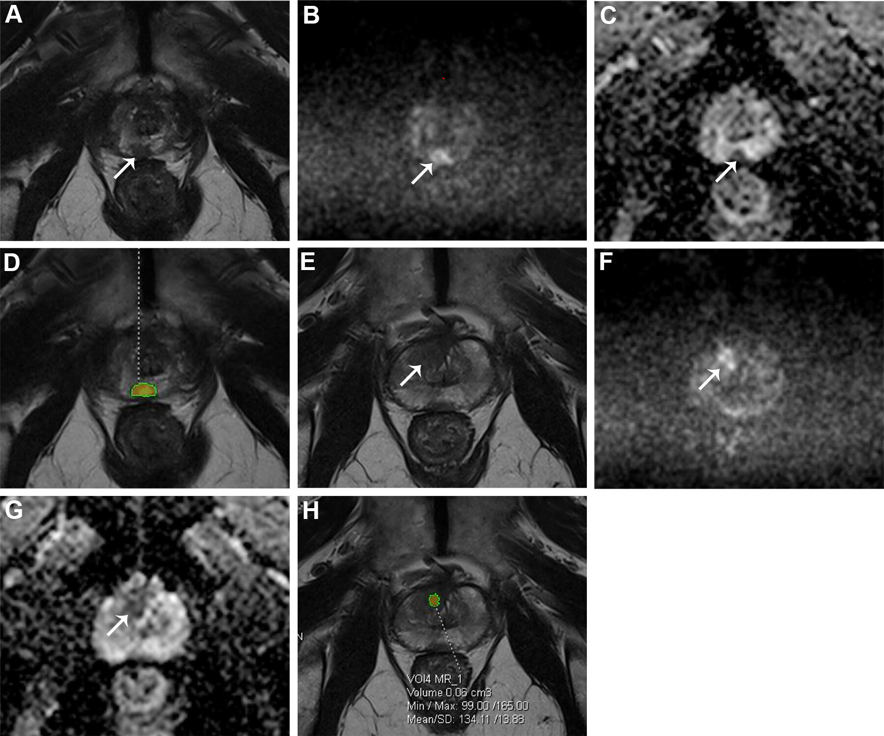 MRI scans show two areas of clinically significant prostate cancer in a 65-year-old man with a prostate-specific antigen level of 8.23 ng/mL. Images are (A, E) axial T2-weighted images, (B, F) axial diffusion-weighted images obtained with a b value of 1500 sec/mm2, (C, G) axial apparent diffusion coefficient images, and (D, H) lesion masks generated by the deep learning algorithm (DLA) on T2-weighted images. The DLA detected a lesion in the right posteromedial peripheral zone of the apex (D), which was assigned as Prostate Imaging Reporting and Data System (PI-RADS) 4. A radiologist also detected the lesion and assigned it PI-RADS 4 (arrow in A-C). A lesion in the right anterior transition zone (H) was detected by the DLA, which was assigned PI-RADS 4. The radiologist did not detect the lesion (arrow in E-G). Both lesions were confirmed as prostate cancer with Gleason grade group 2. Caption and image courtesy of RSNA.