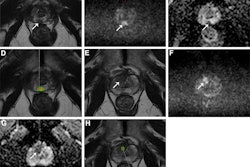 MRI scans show two areas of clinically significant prostate cancer in a 65-year-old man with a prostate-specific antigen level of 8.23 ng/mL. Images are (A, E) axial T2-weighted images, (B, F) axial diffusion-weighted images obtained with a b value of 1500 sec/mm2, (C, G) axial apparent diffusion coefficient images, and (D, H) lesion masks generated by the deep learning algorithm (DLA) on T2-weighted images. The DLA detected a lesion in the right posteromedial peripheral zone of the apex (D), which was assigned as Prostate Imaging Reporting and Data System (PI-RADS) 4. A radiologist also detected the lesion and assigned it PI-RADS 4 (arrow in A-C). A lesion in the right anterior transition zone (H) was detected by the DLA, which was assigned PI-RADS 4. The radiologist did not detect the lesion (arrow in E-G). Both lesions were confirmed as prostate cancer with Gleason grade group 2. Caption and image courtesy of RSNA.