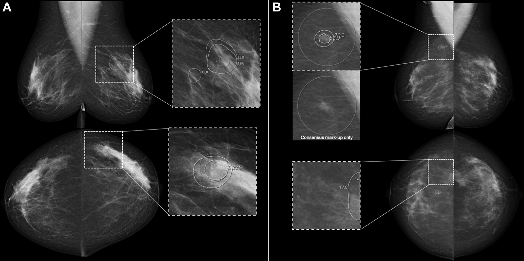 Full-field digital screening mammograms in participants recalled by the consensus discussion after being flagged by artificial intelligence (AI) computer-aided detection (CAD) but not by either of the two radiologists. (A) Mammogram with AI CAD score of 73 for a 55-year-old woman diagnosed with grade 3 in situ cancer and T1 (9-mm) invasive cancer in the left breast and lymph node metastasis. (B) Mammogram with AI CAD score of 54 for a 49-year-old woman diagnosed with grade 2 in situ cancer and T1 (6-mm) invasive cancer in the right breast and without lymph node metastasis. All images and caption courtesy of the RSNA.