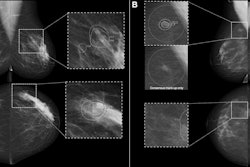 Full-field digital screening mammograms in participants recalled by the consensus discussion after being flagged by artificial intelligence (AI) computer-aided detection (CAD) but not by either of the two radiologists. (A) Mammogram with AI CAD score of 73 for a 55-year-old woman diagnosed with grade 3 in situ cancer and T1 (9-mm) invasive cancer in the left breast and lymph node metastasis. (B) Mammogram with AI CAD score of 54 for a 49-year-old woman diagnosed with grade 2 in situ cancer and T1 (6-mm) invasive cancer in the right breast and without lymph node metastasis. All images and caption courtesy of the RSNA.