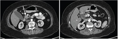 70-year-old woman with pancreatic ductal adenocarcinoma. Left: Preoperative axial arterial (pancreatic) phase image shows primary tumor in pancreatic head (arrow), which was deemed resectable. Right: More superior axial image in same phase shows dilated main pancreatic duct (arrow). Thinnest CT slices were 1 mm thick. Whipple procedure was completed. Images and caption courtesy of the ARRS.