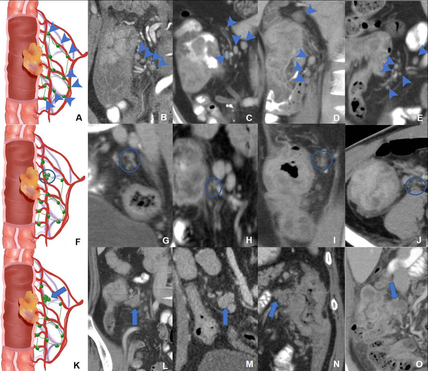 Schematic diagrams and representative images of different distribution patterns of region lymph nodes detected at CT. (A) Vascular distribution pattern: All regional lymph nodes detected at CT have regular borders and are distributed along the vessels (arrowheads). (B-E) Coronal CT images in a (B) 34-year-old woman, (C) 51-year-old man, (D) 37-year-old man, and (E) 40-year-old man with microsatellite instability-high (MSI-H) colon cancer show multiple clear lymph nodes distributed along the supplying arteries or draining veins (arrowheads). (F) Jammed cluster pattern: At least three lymph nodes with blurred margins and clustered (circle). (G-I) Coronal CT images in a (G) 29-year-old man, (H) 35-year-old man, and (I) 67-year-old man and (J) axial CT image in a 43-year-old man with MSI-H colon cancer show several lymph nodes with blurred margins and clustered (circle). Movies 1-4 provide more details. (K) Fused pattern: Several poorly defined lymph nodes clustered and fused together (arrow). (L-O) Coronal CT images in a (L) 63-year-old woman, (M) 59-year-old man, (N) 49-year-old woman, and (O) 73-year-old man with MSI-H colon cancers show several lymph nodes fused (arrow). Image courtesy of Radiology.