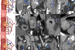 Schematic diagrams and representative images of different distribution patterns of region lymph nodes detected at CT. (A) Vascular distribution pattern: All regional lymph nodes detected at CT have regular borders and are distributed along the vessels (arrowheads). (B-E) Coronal CT images in a (B) 34-year-old woman, (C) 51-year-old man, (D) 37-year-old man, and (E) 40-year-old man with microsatellite instability-high (MSI-H) colon cancer show multiple clear lymph nodes distributed along the supplying arteries or draining veins (arrowheads). (F) Jammed cluster pattern: At least three lymph nodes with blurred margins and clustered (circle). (G-I) Coronal CT images in a (G) 29-year-old man, (H) 35-year-old man, and (I) 67-year-old man and (J) axial CT image in a 43-year-old man with MSI-H colon cancer show several lymph nodes with blurred margins and clustered (circle). Movies 1-4 provide more details. (K) Fused pattern: Several poorly defined lymph nodes clustered and fused together (arrow). (L-O) Coronal CT images in a (L) 63-year-old woman, (M) 59-year-old man, (N) 49-year-old woman, and (O) 73-year-old man with MSI-H colon cancers show several lymph nodes fused (arrow). Image courtesy of Radiology.