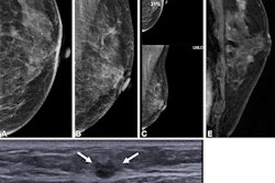 Images depict a 65-year-old patient with contralateral second breast cancer 6.3 years after right mastectomy. (A) Left craniocaudal and (B) mediolateral oblique mammograms assessed as benign. (C) The AI algorithm outlined a lesion with a score of 31 on the craniocaudal view. (D) A supplemental axial ultrasound scan, which was obtained on the same day as the mammogram, shows an irregular hypoechoic mass (arrows) in the left upper central breast. (E) Preoperative sagittal contrast-enhanced T1-weighted MRI scan shows the corresponding enhancing mass (arrow) in the left upper center. The mass was proven to be ductal carcinoma in situ.